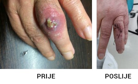infekcija nakon uboda insekta-prije i polsije