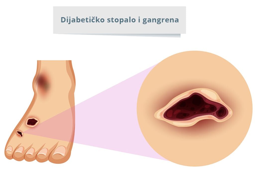 Dijabetičko stopalo i dijabetička gangrena